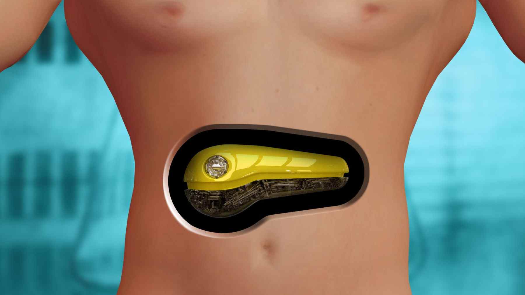 Implante de páncreas artificial con células vivas en el abdomen, diseñado para liberar insulina de forma autónoma.